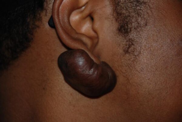 Keloid Treatment
