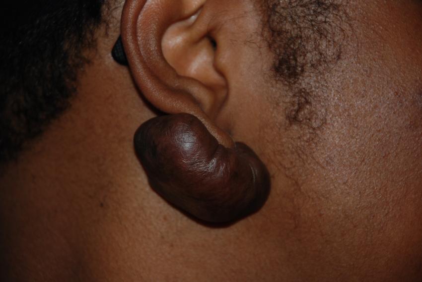 Keloid Treatment - Image 1