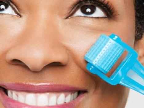 Derma Needling For Acne Scarring